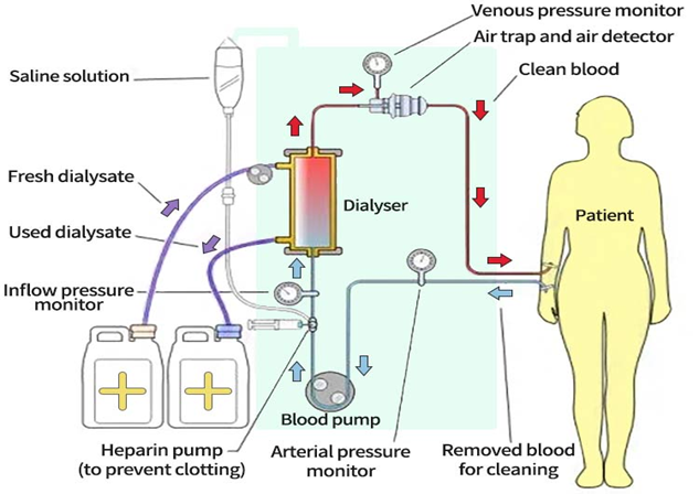 نحوه عملکرد فیلتر دستگاه دیالیز